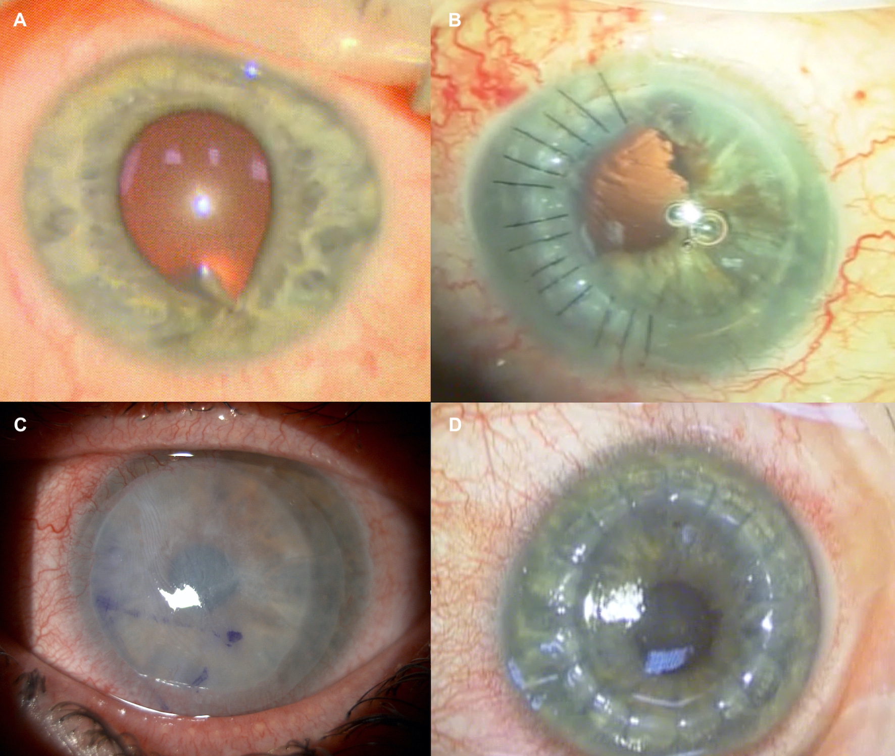 From top right clockwise: A shows penetrating corneal injury with iris distortion inferiorly; B corneal laceration repair; C amniotic membrane in a contact lens delivery system (Omnigen) to aid re-epithelisation after chemical injury; D corneal transplantation required for scarring affecting the visual axis