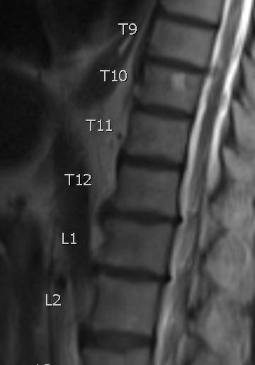 T10 Hemangioma