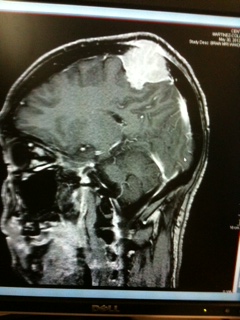 Meningioma with hyperostosis and bone infiltration