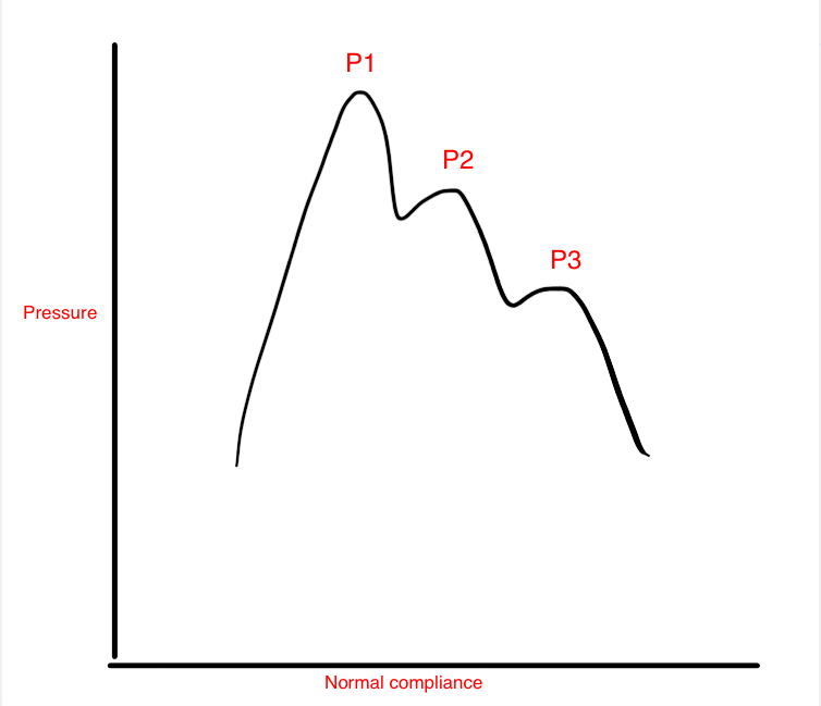 Intracranial pressure waveform showing normal compliance