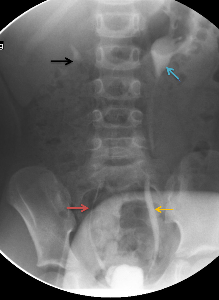 Fluoroscopic spot image of voiding cystourethrogram (VCU) showing bilateral vesicoureteral reflux (VUR)