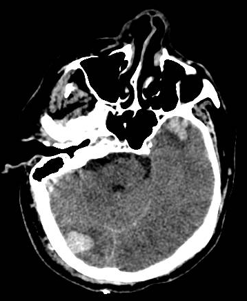 Right occipital cerebral contusion with contrecoup left temporal cerebral contusion