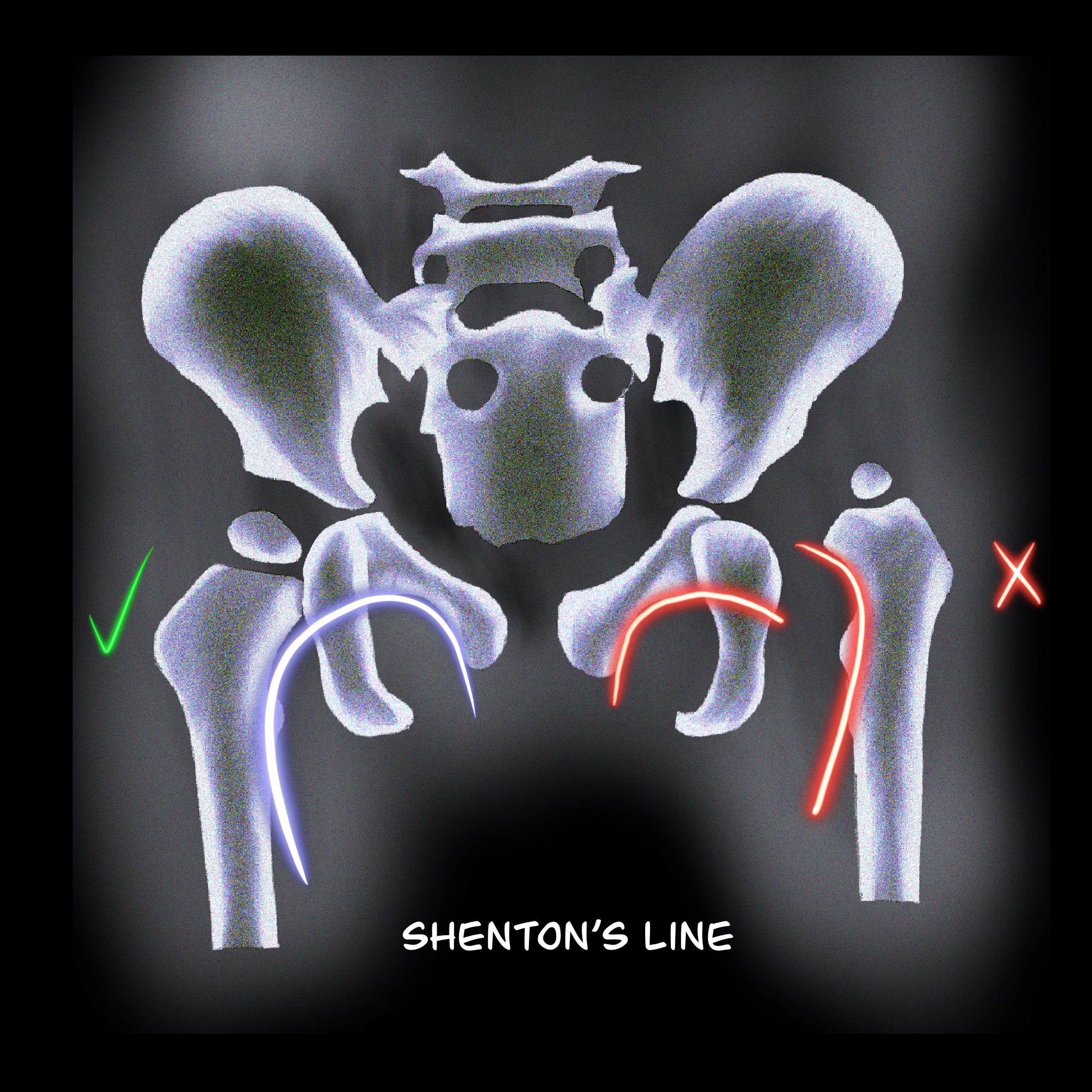 Figure 3: Shenton´s line. Any disruption of the line indicates an abnormality.