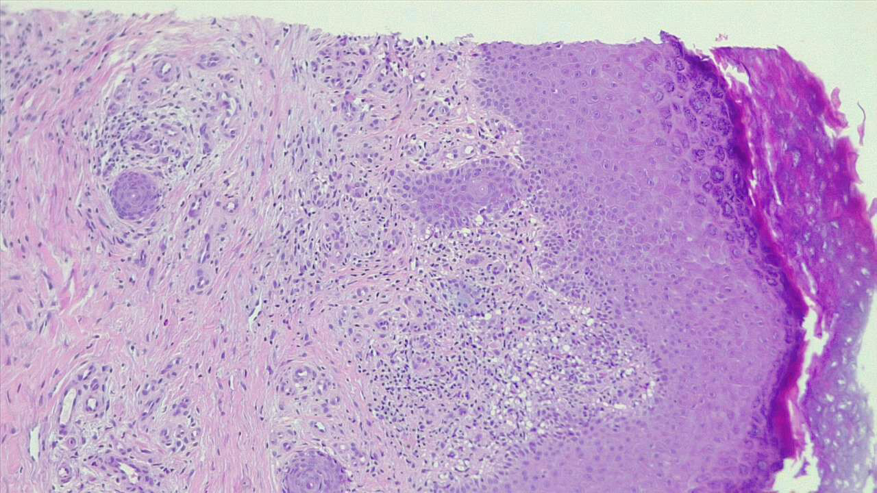 Dermatitis, H/E 4x.