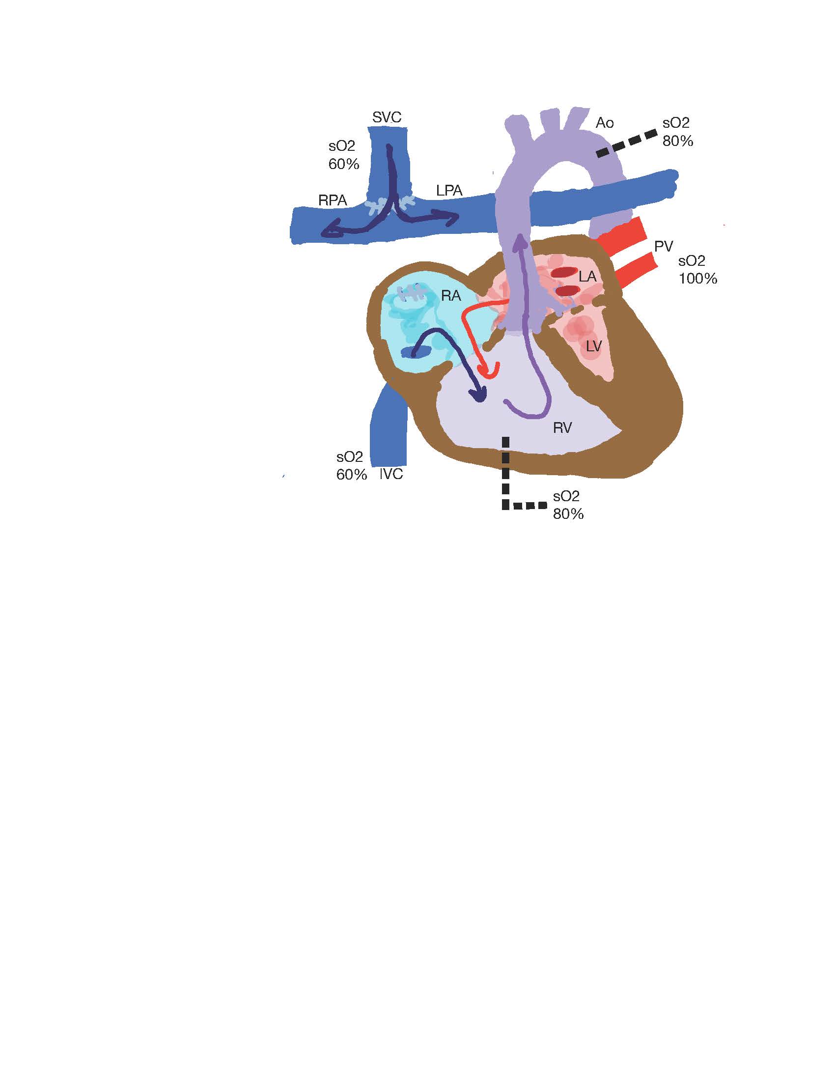 Superior Cavopulmonary Anastomosis