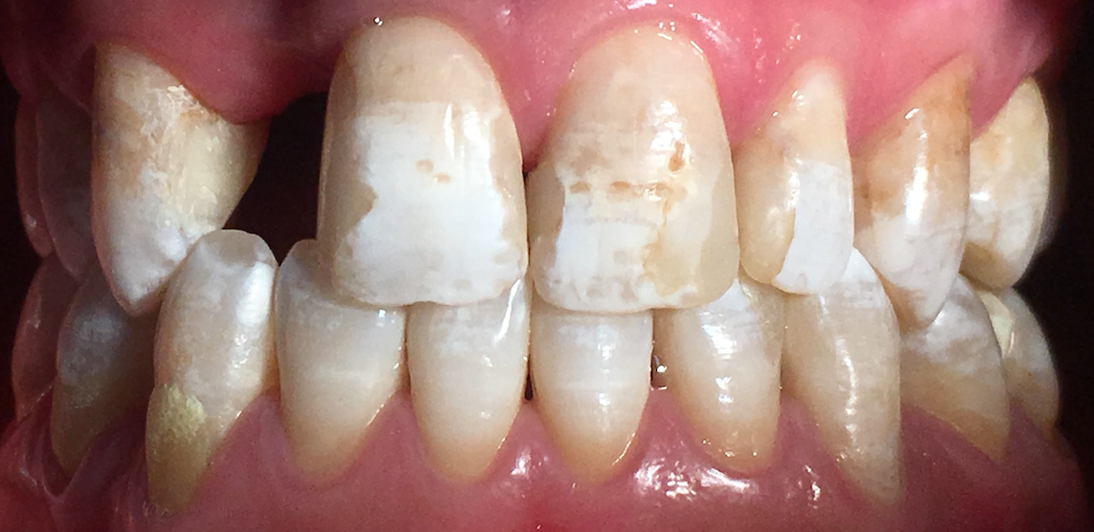 Dental fluorosis