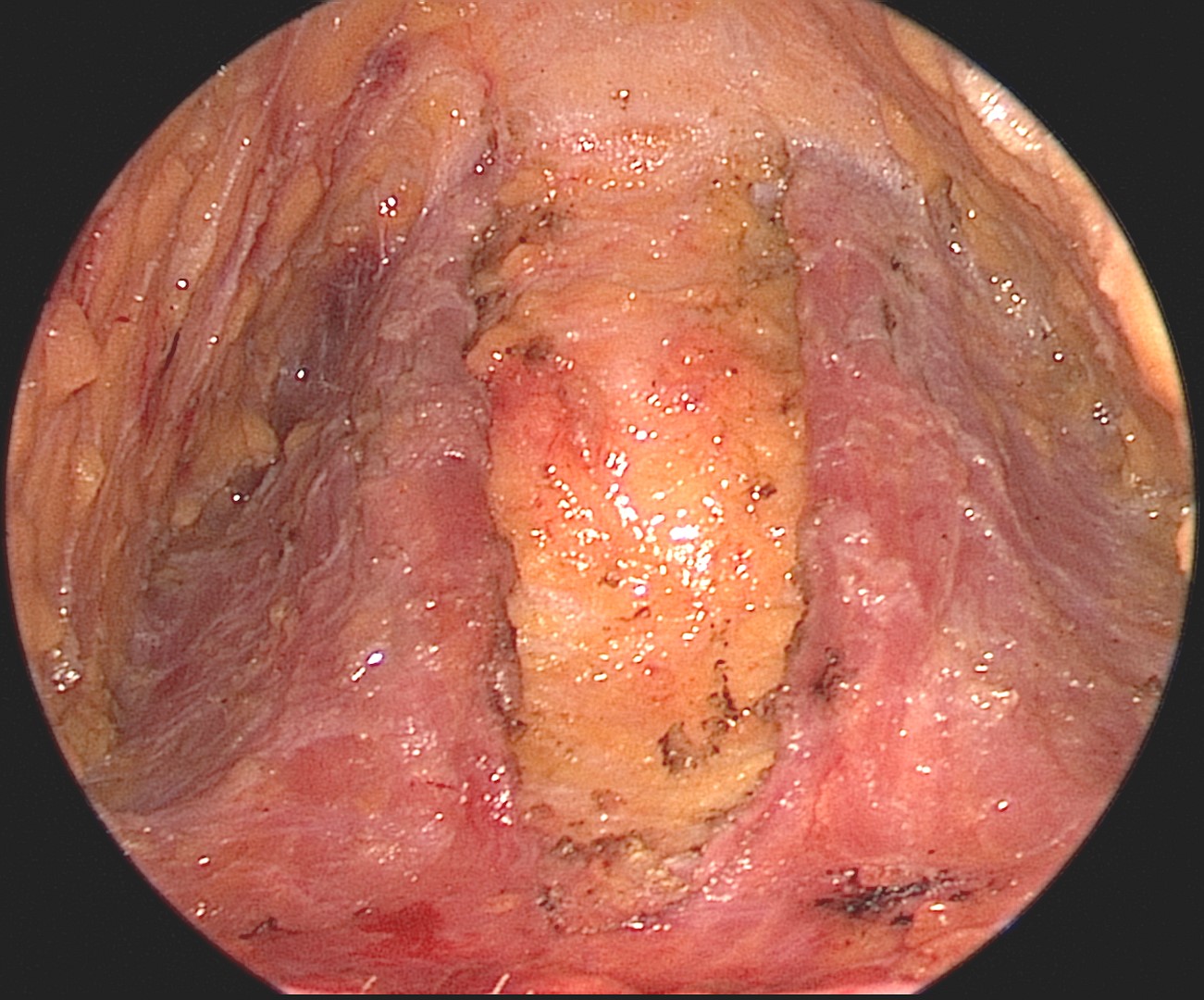 <p>Midline Dehiscence of the Muscles