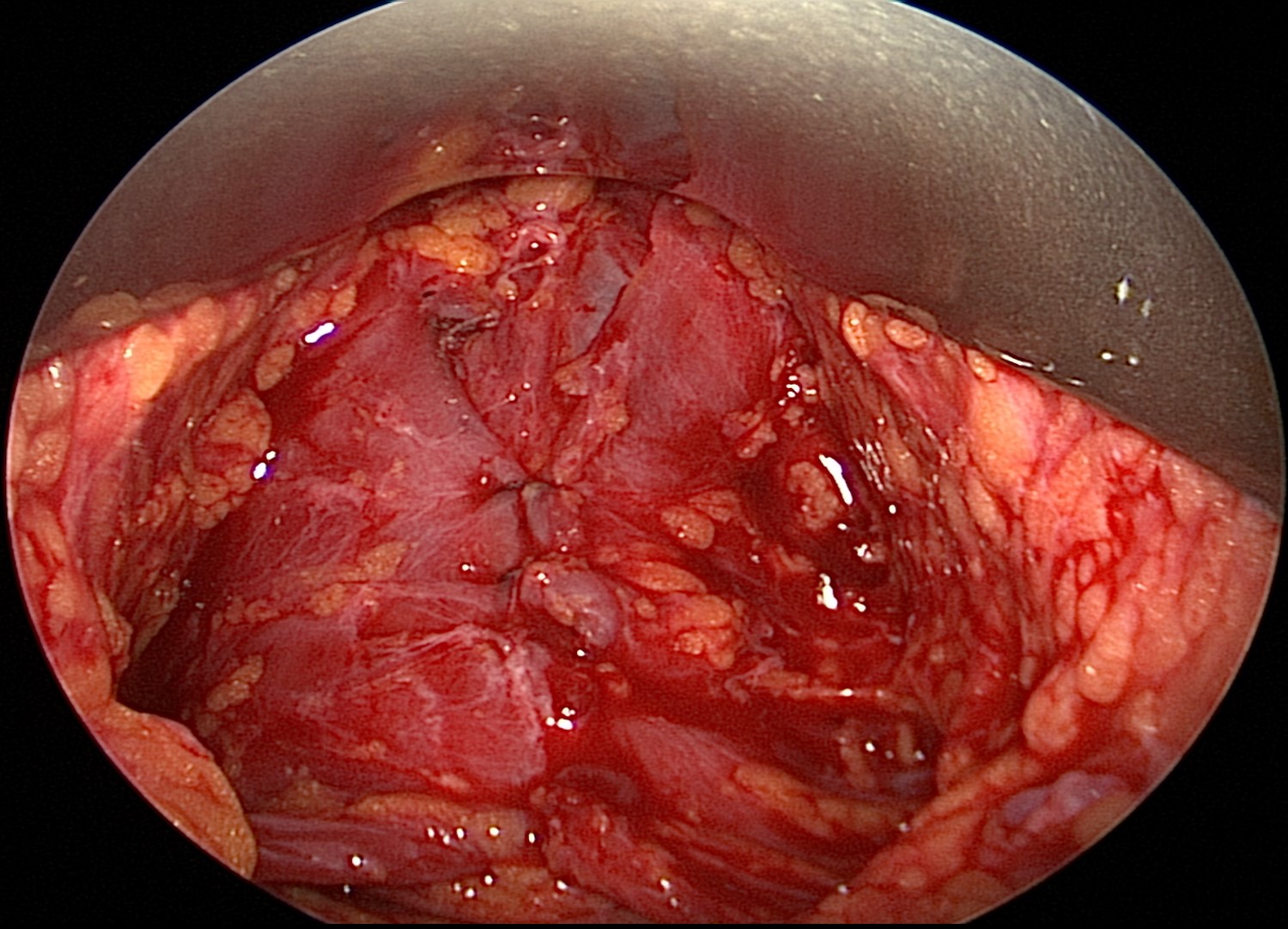 <p>Endoscopic View of the Platysma After Suturing