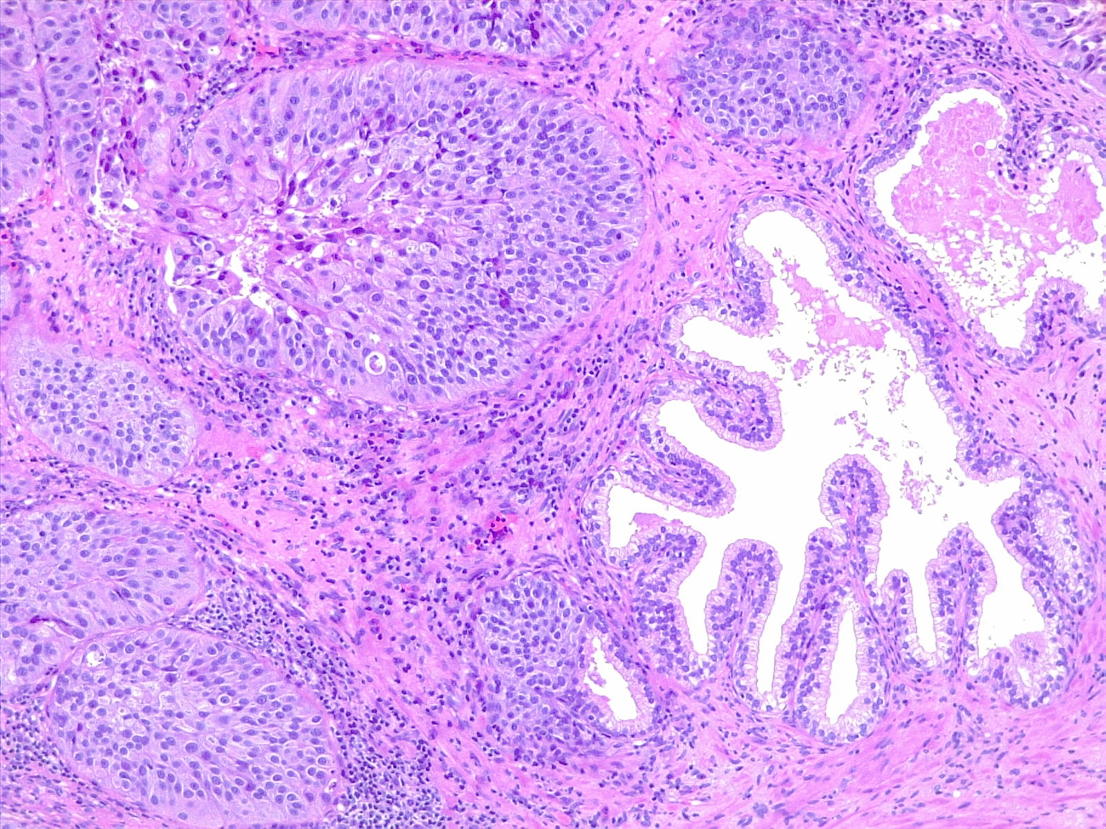 Urothelial carcinoma, prostatic infiltration. 10x H/E.