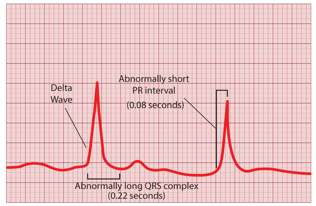 Wolff-Parkinson-White Syndrome