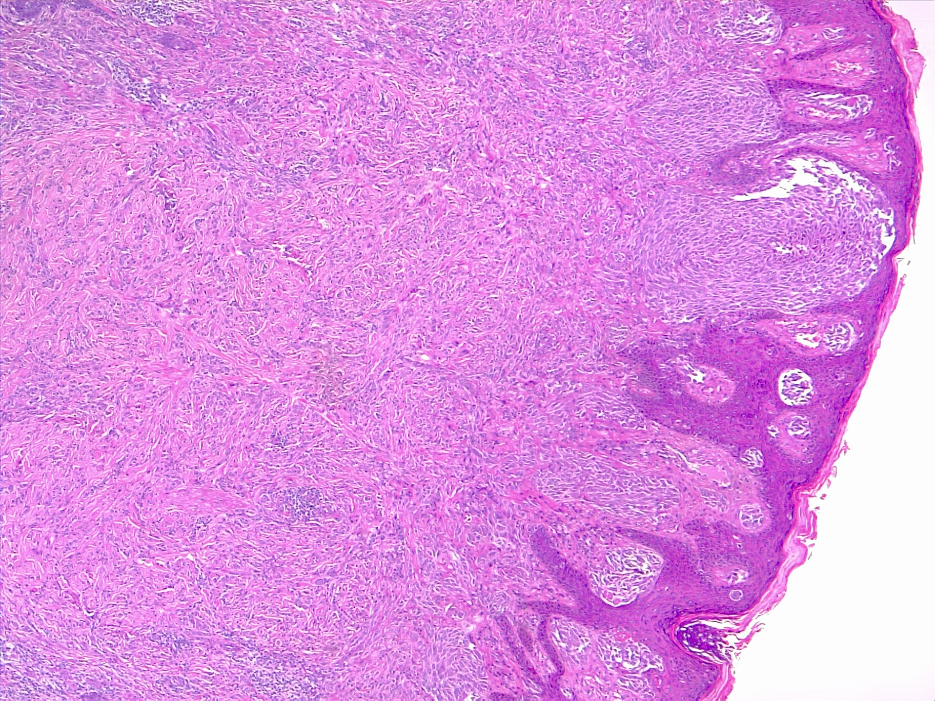 Atypical proliferation of melanocytes in the dermis, in a diffuse pattern