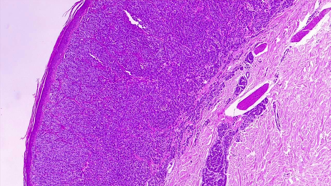 Melanoma of the skin. Nodular melanoma, vertical growth phase, deep dermal invasion. H/E 4x