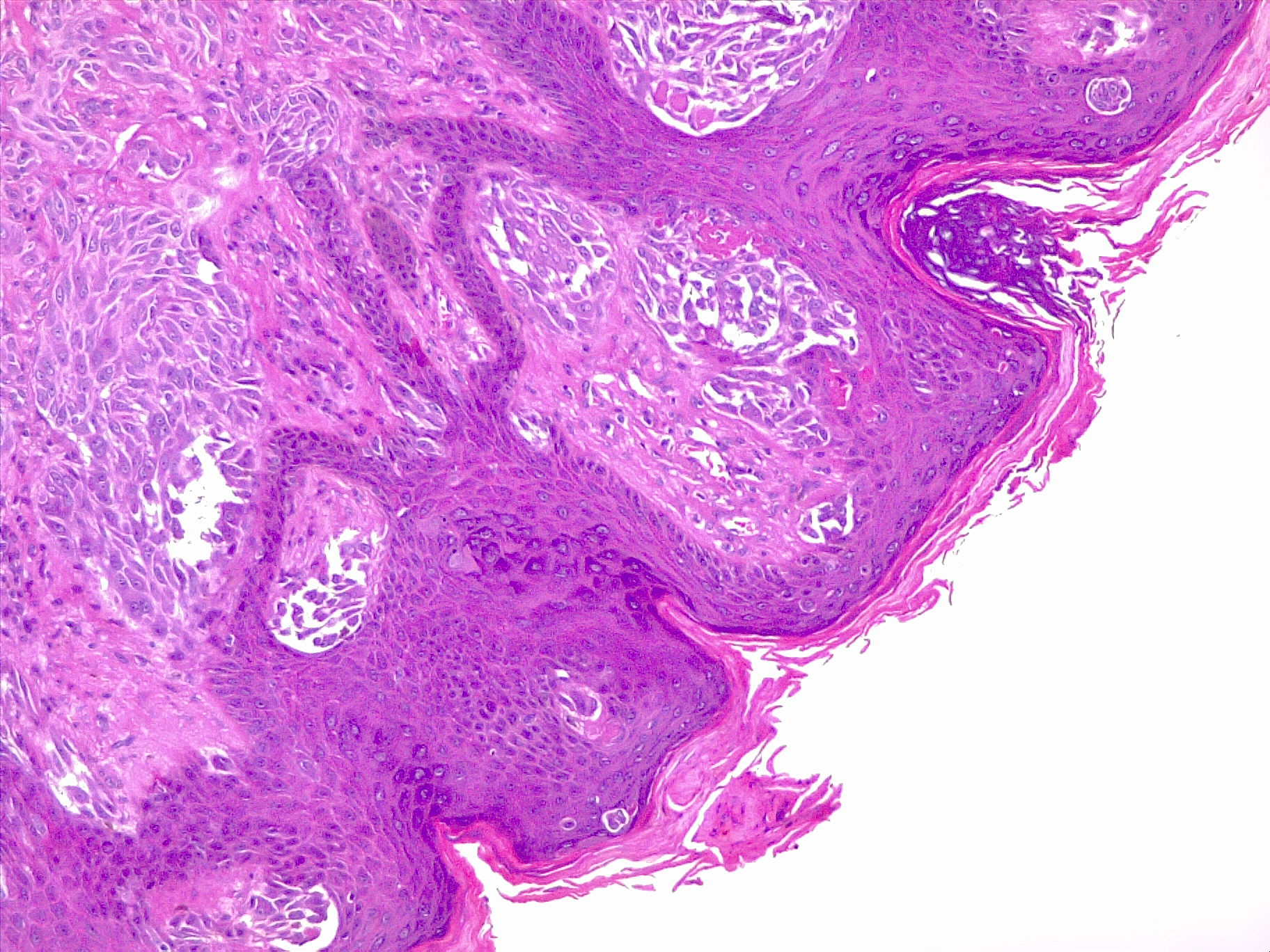 <p>Malignant Melanoma, Superficial Spread