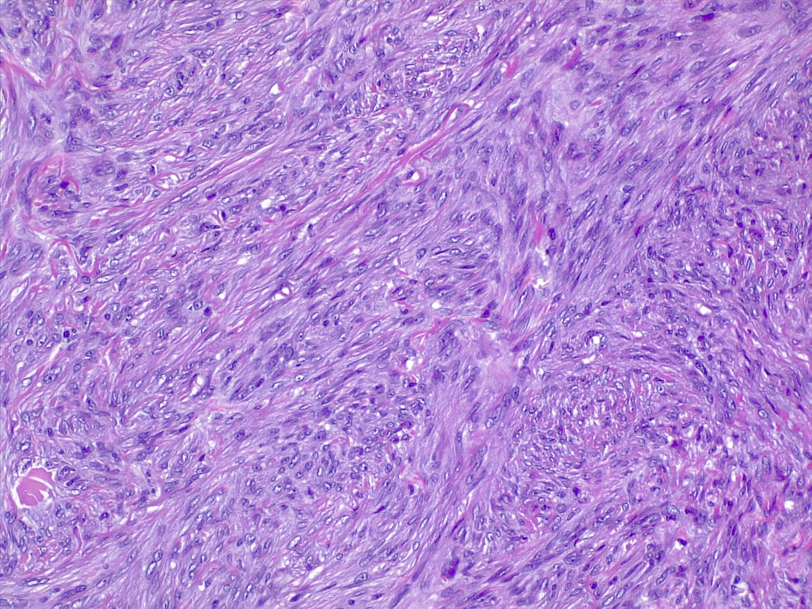 Spindle cells with bland nuclear features, disposed in short fascicles. H/E stain.