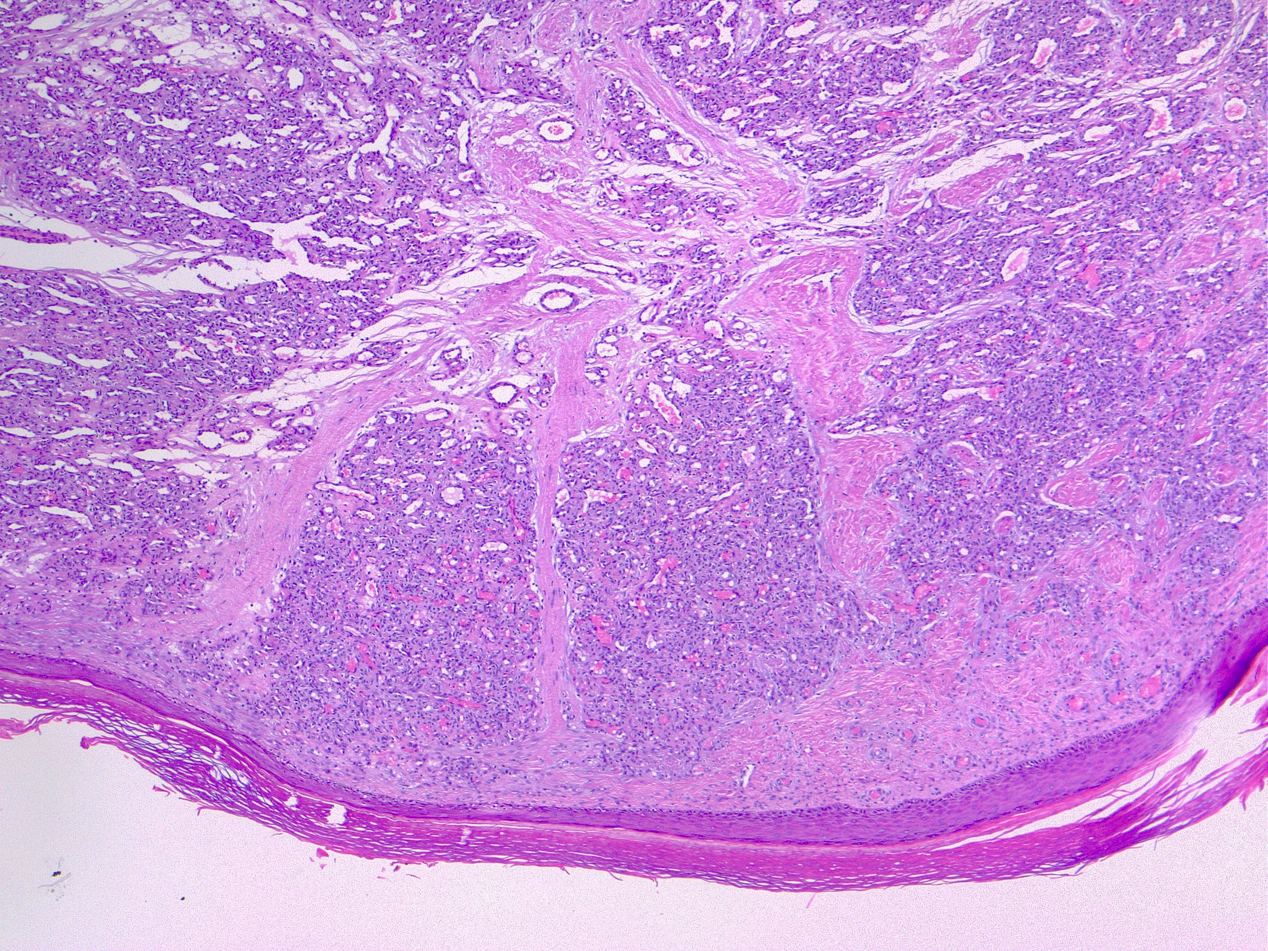 Pyogenic granuloma, H/E 4x. Lobular arrangement of the capillary vessels is a common feature.