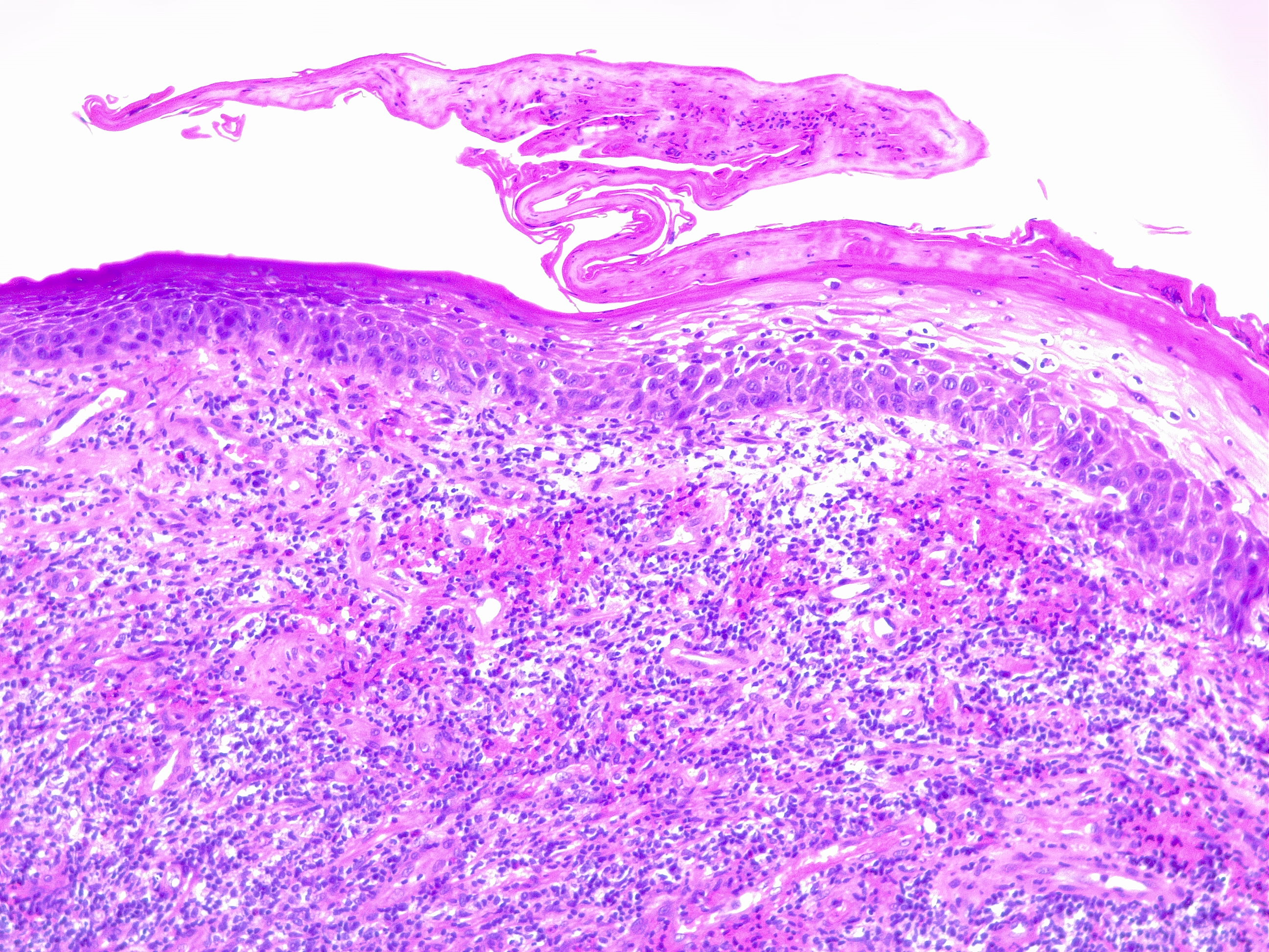 Pyogenic granuloma H/E 10x