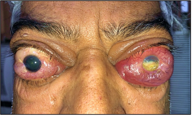 Left corneal exposure keratopathy with bilateral optic nerve involvement in a 50 year old male patient with Graves Disease.