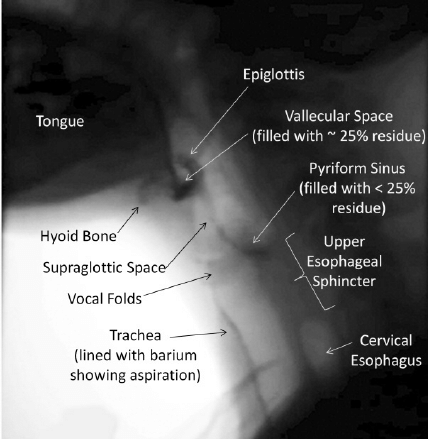 A still x-ray image, taken from a videofluoroscopic swallowing study