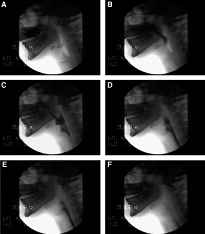 A: Bolus hold position, glossopalatal seal maintained