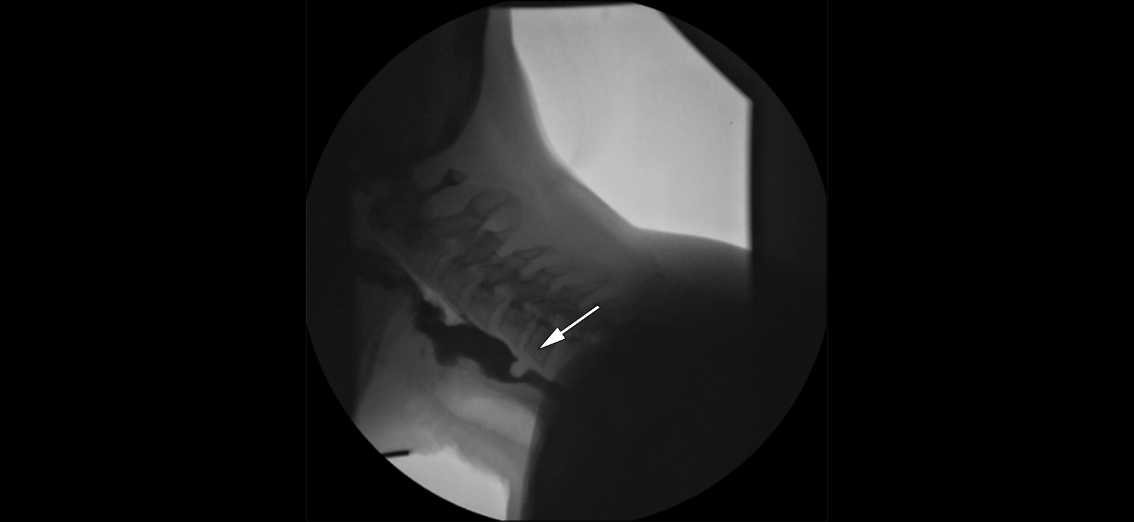 Lateral Video Fluoroscopic Swallowing Study image shows a cricopharyngeal bar (arrow), a prominent cricopharyngeal muscle, without aspiration