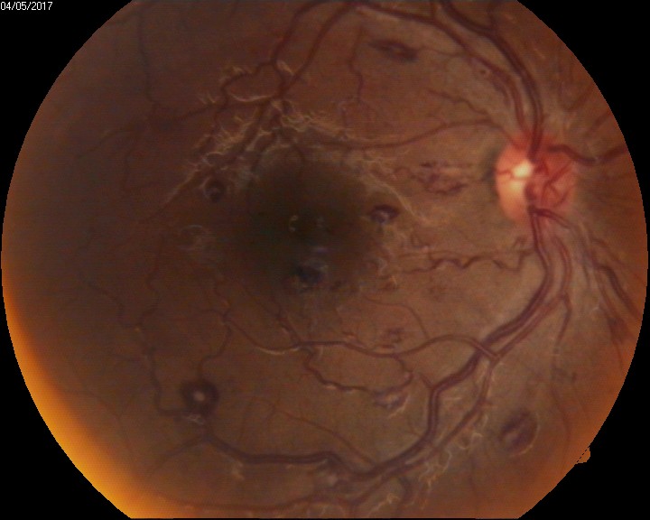 Intraocular hemorrhage - Roth Spots