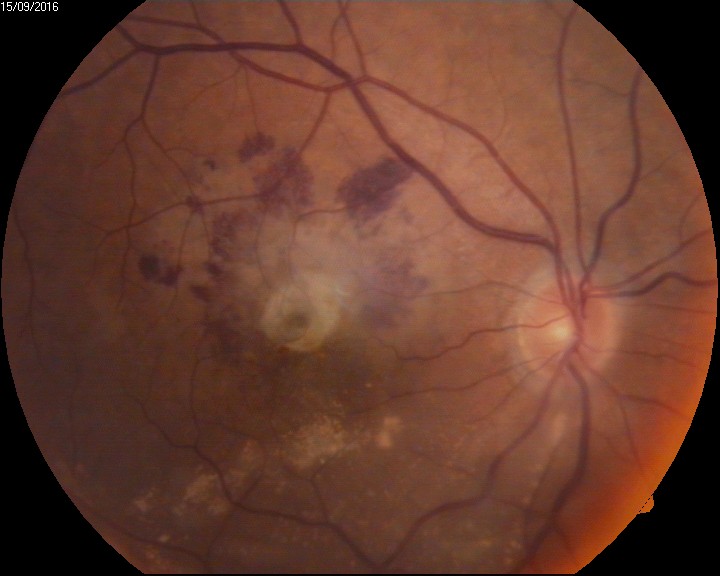 Intraocular hemorrhage - hemorrhagic CNVM