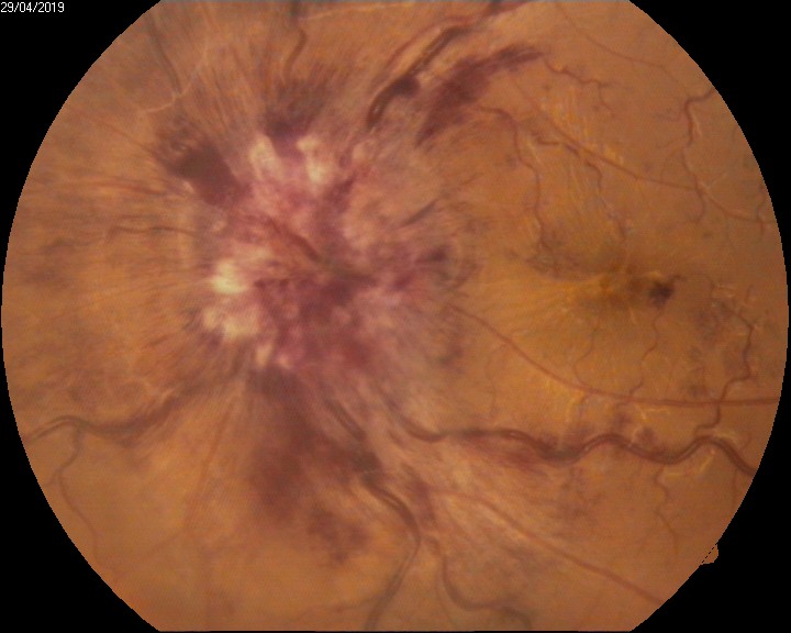 Intraocular hemorrhage - Disc hemorrhage in Grade 4 Papilloedema