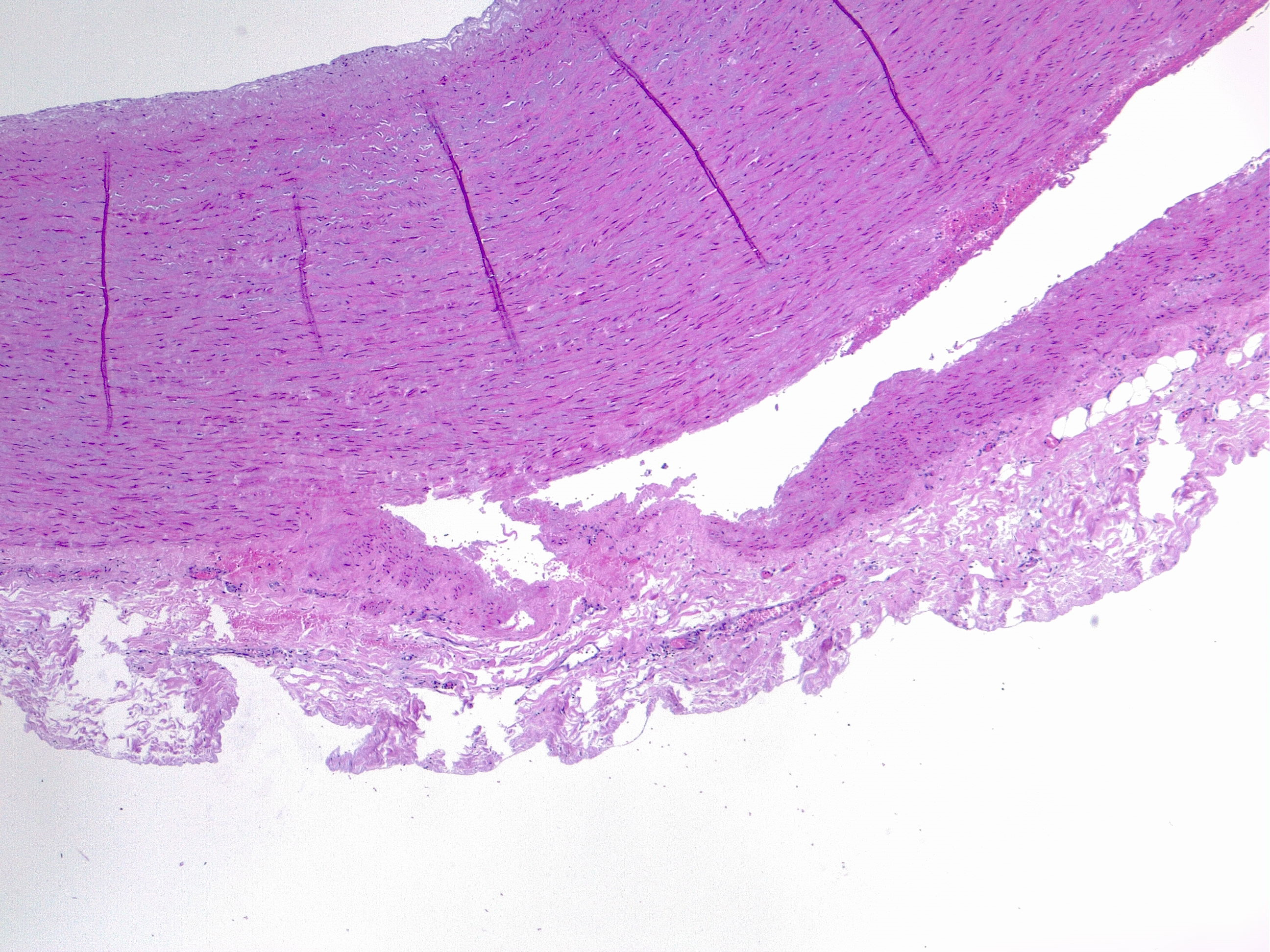 Aortic dissection