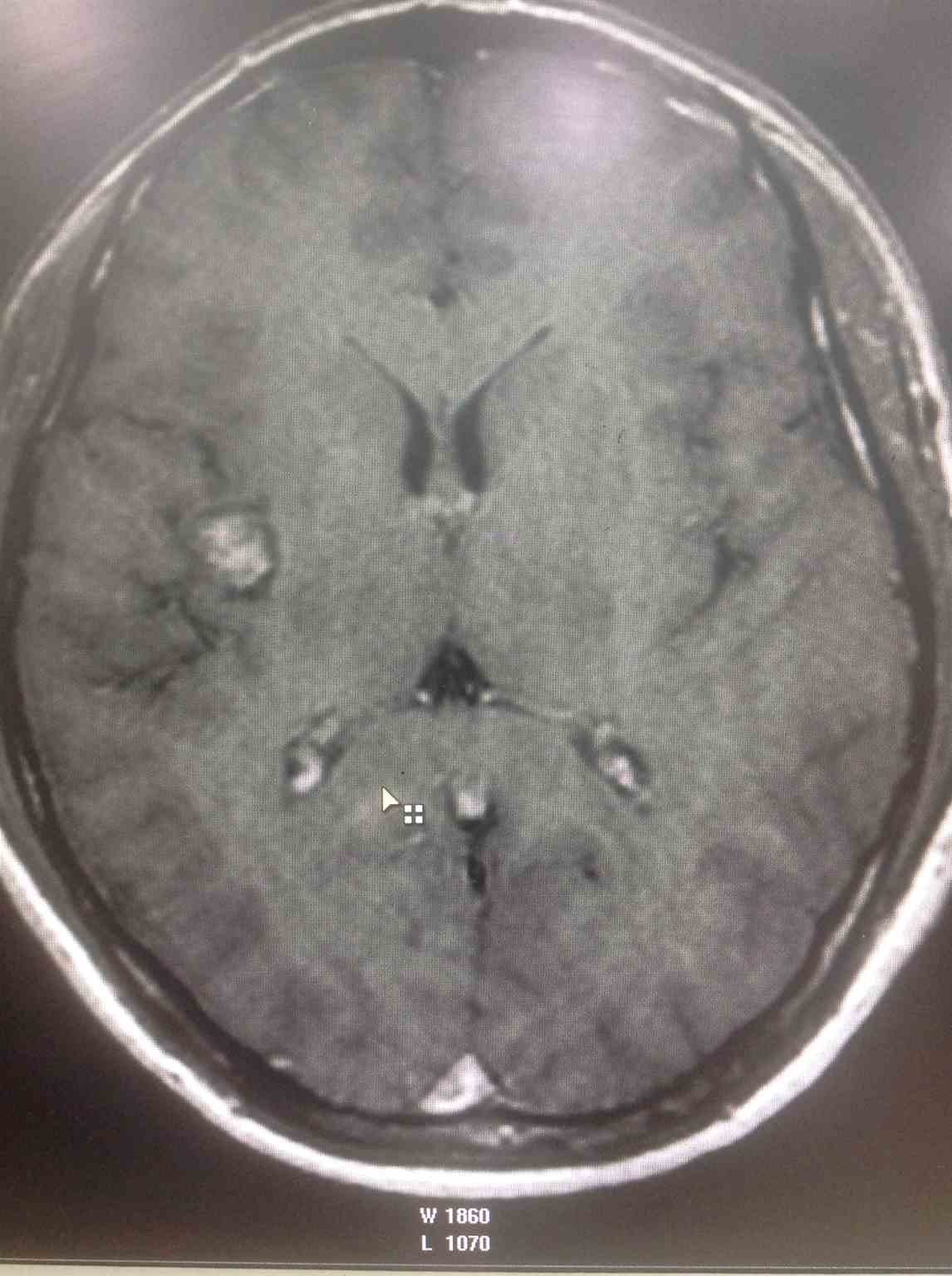 Post contrast T1W image shows  absence of any associated Developmental Venous Anomaly