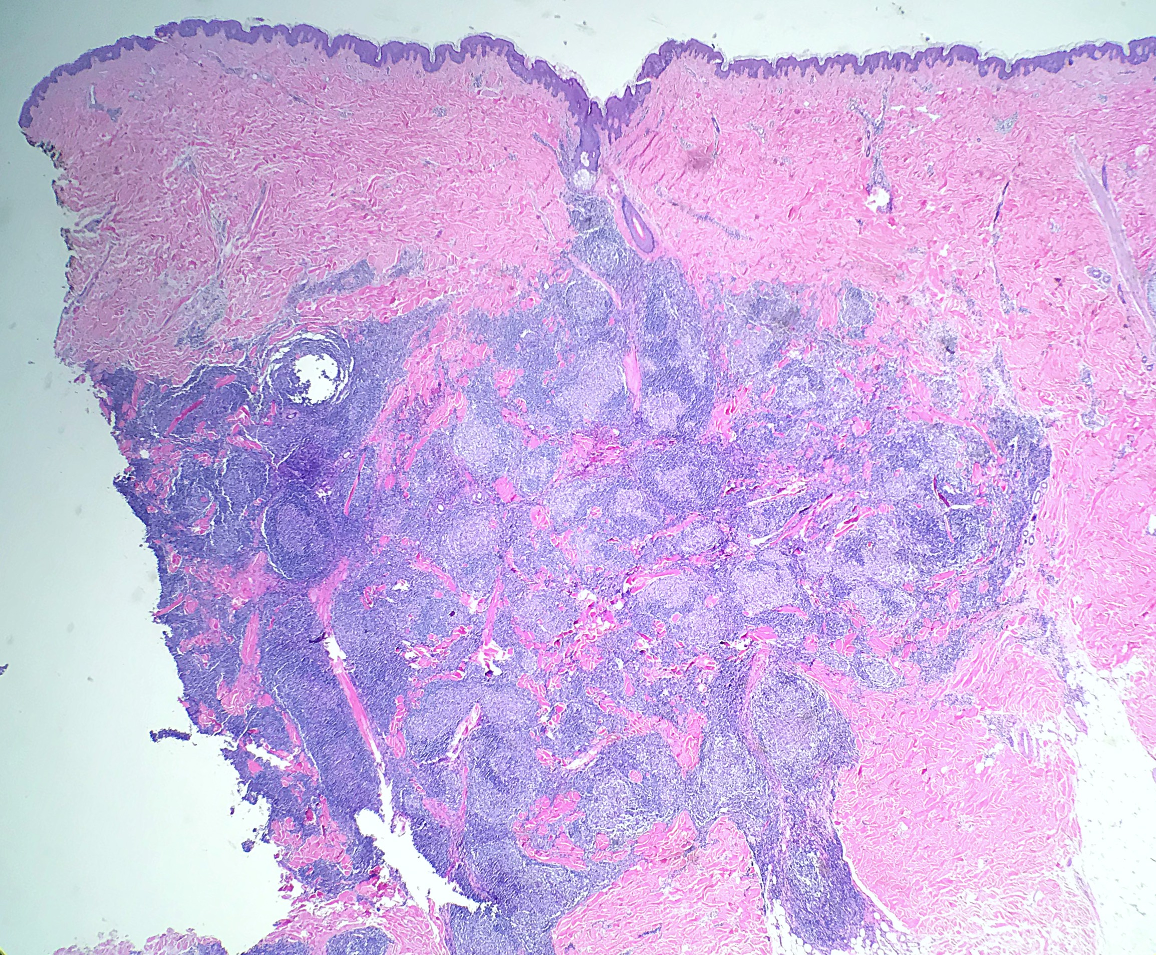 <p>Primary Cutaneous Follicle Center Lymphoma, Biopsy