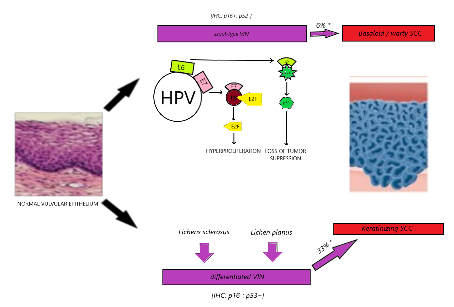 Vulvar cancer development