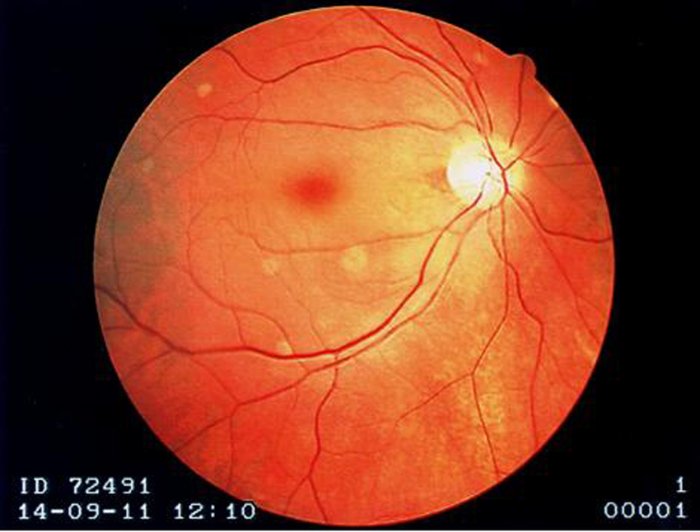 Fundoscopic exam findings in Central Retinal Artery Occlusions which includes a cherry red fovea, optic disk pallor, and boxc