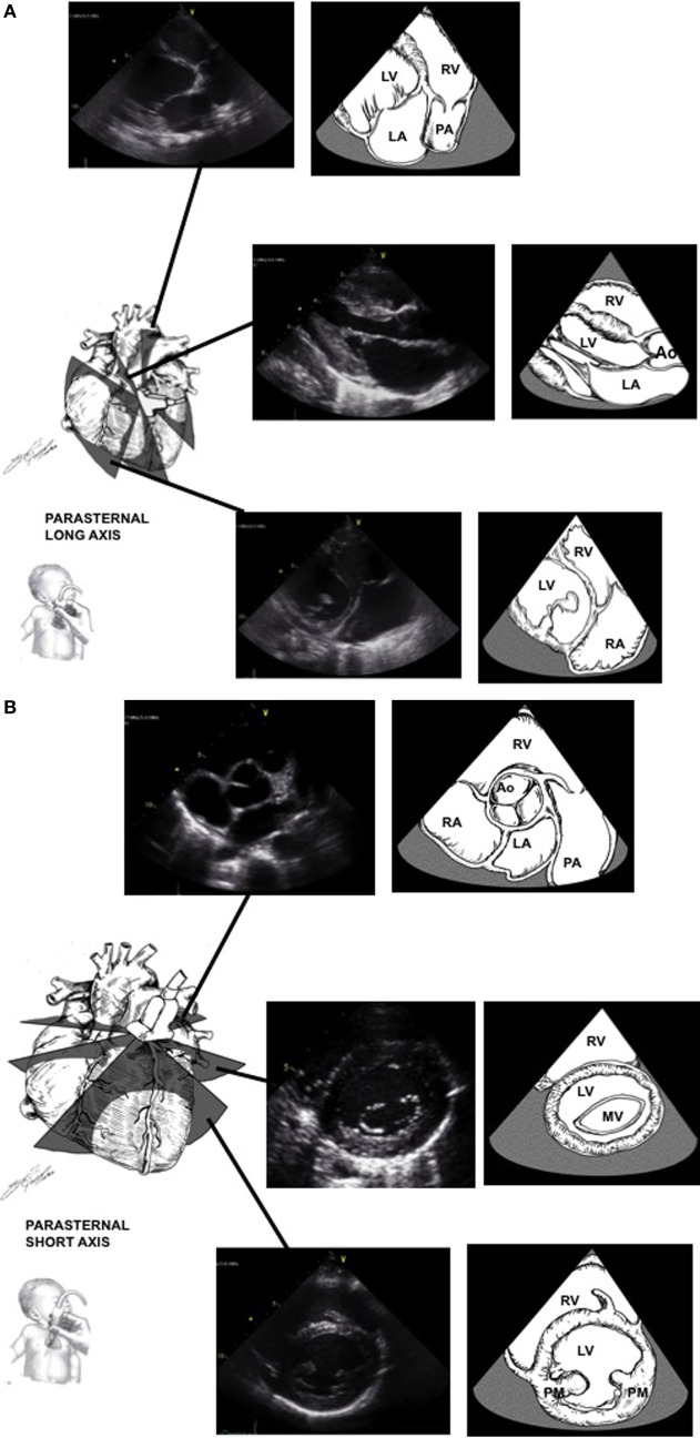 Pediatric Echocardiography Parasternal Windows.