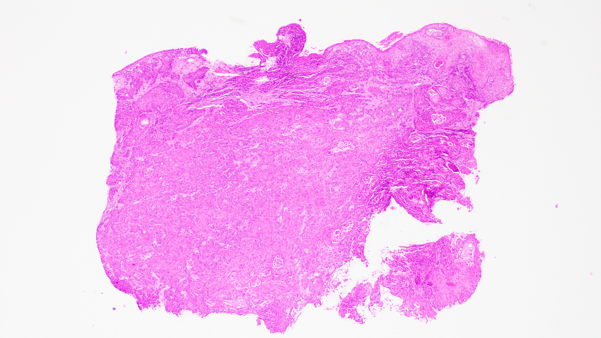 Histopathology slide of Vulvar Squamous cell Carcinoma, Low power field, H&E stain.