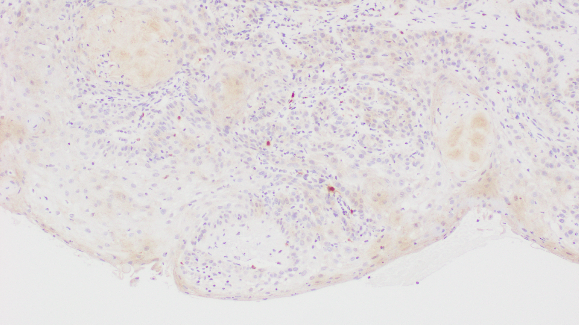 Histopathology Slide of Vulvar Squamous Cell Carcinoma with P16 stain, showing positivity for Human Papilloma virus(HPV 16).