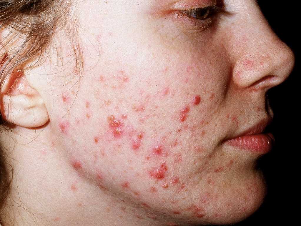 Acne Vulgaris