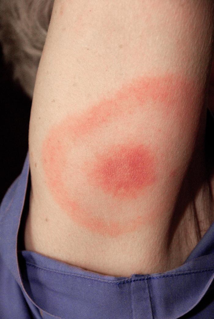 Lyme disease "bulls eye" rash.