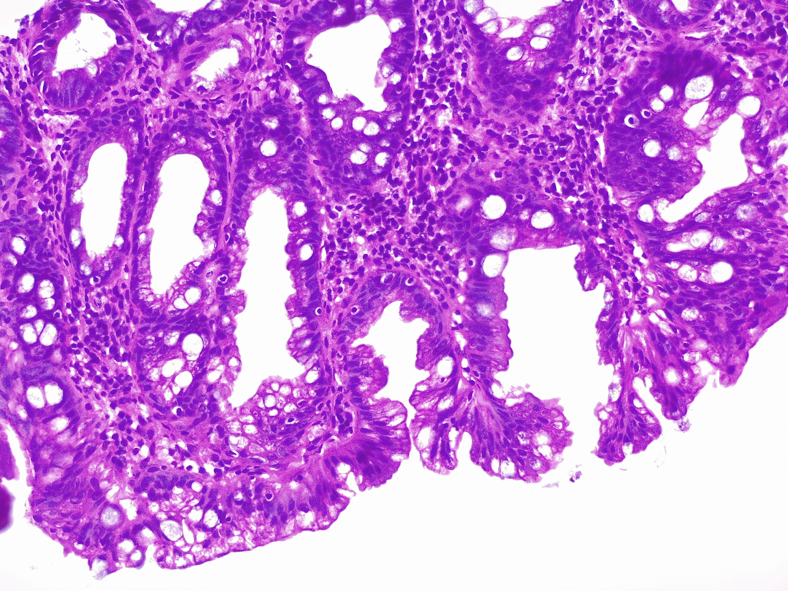 Colon biopsy, polypectomy following a screening colonoscopy. Hyperplastic glands.