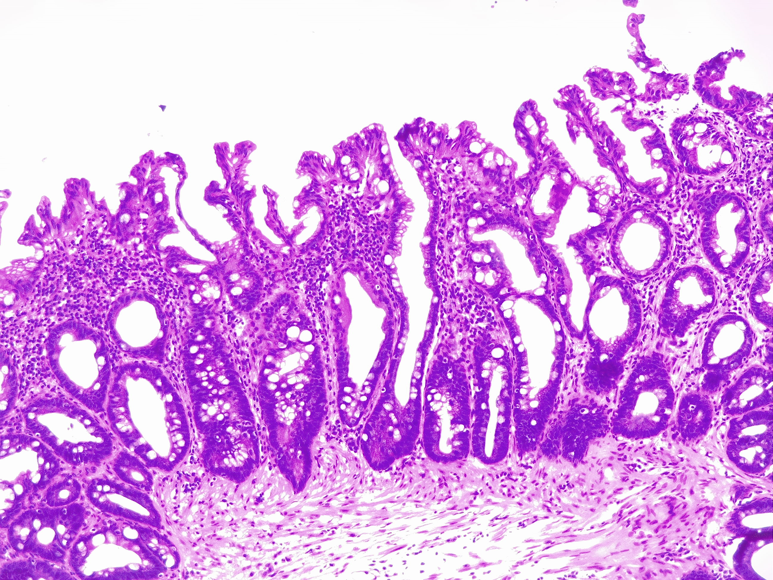 Hyperplastic polyp of the colon