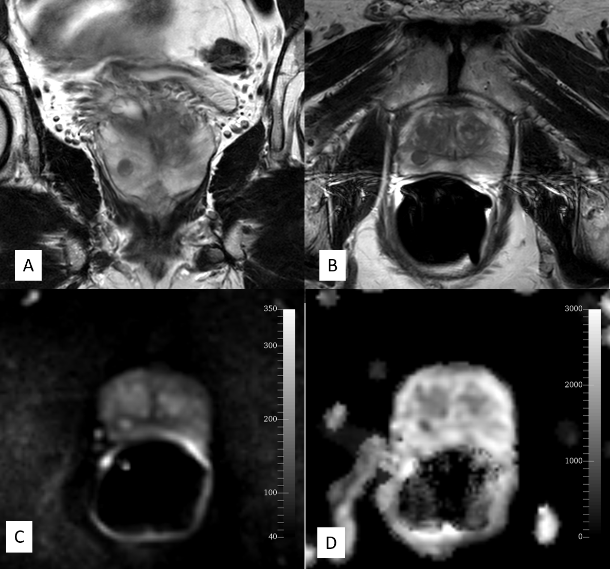 MRI of normal prostate using endorectal coil (black coil in the rectum)