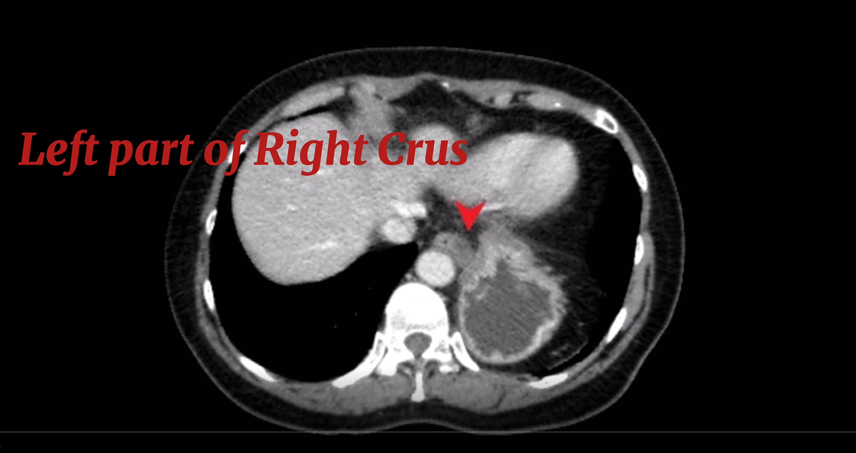 CT scan  sagittal view showing left part of Right crus of Diaphragm