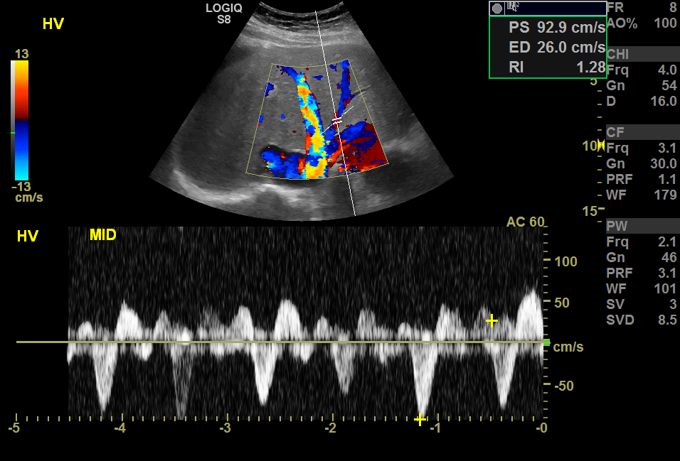 <p>Color Doppler Ultrasound, Hepatic Veins With Hepatic Venous Waveforms</p>