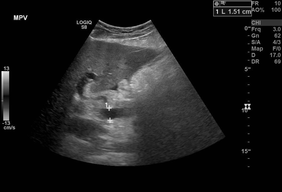 B-Mode ultrasound showing main portal vein diameter of 15.1 millimeters. This is an indirect finding of portal hypertension.