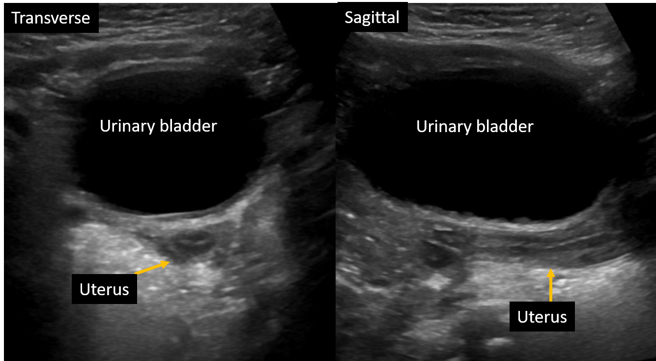 Transabdominal ultrasound : Normal tubular shaped uterus in 2 years old female