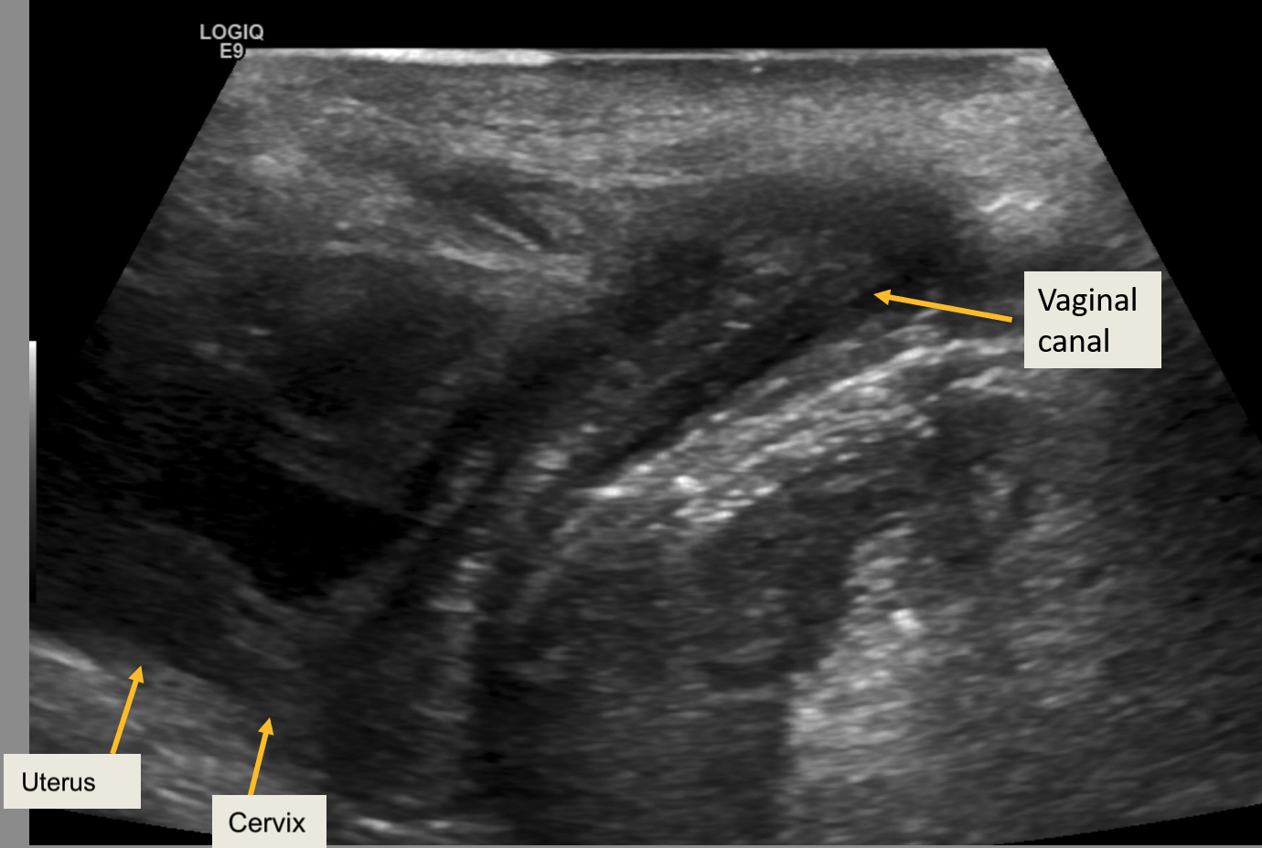 Translabial ultrasound of 2 year female- Normal appearance of vaginal canal, uterus and cervix.