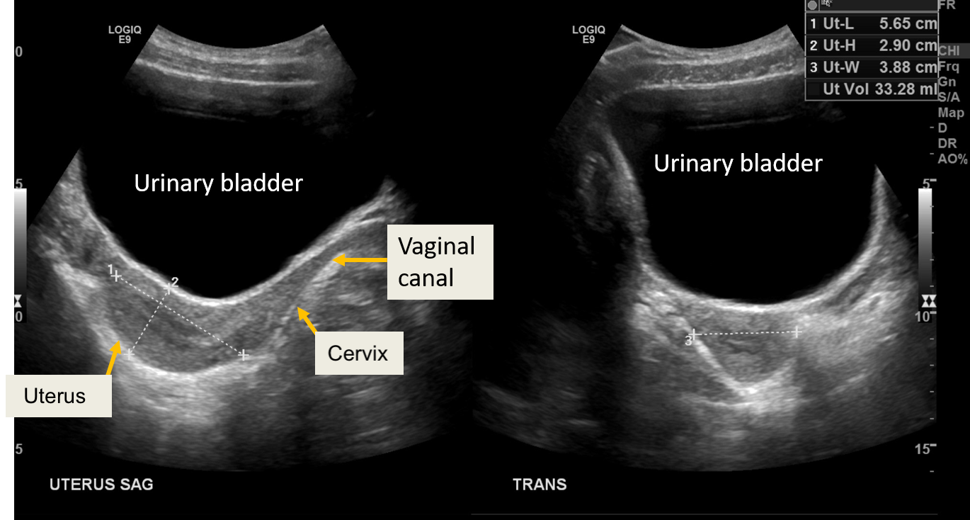 Normal transabdominal ultrasound of uterus in 17 year old female: Post pubertal pear shape of the uterus with more growth of 