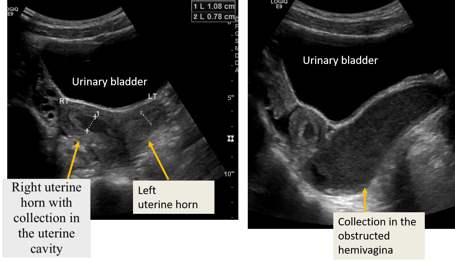 OHVIRA (obstructed hemivagina , ipsilateral renal anomaly) : Transabdominal ultrasound-transverse sections of pelvis- showing two separate uterine horns; obstructed hemivagina with echogenic collection (blood products) in the vaginal cavity and  right uterine horn