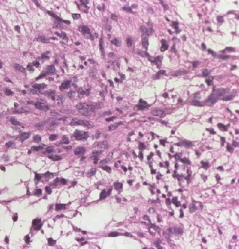 Soft tissue fibrosarcoma