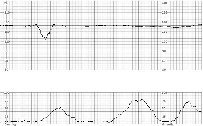 <p>Category II Tracing