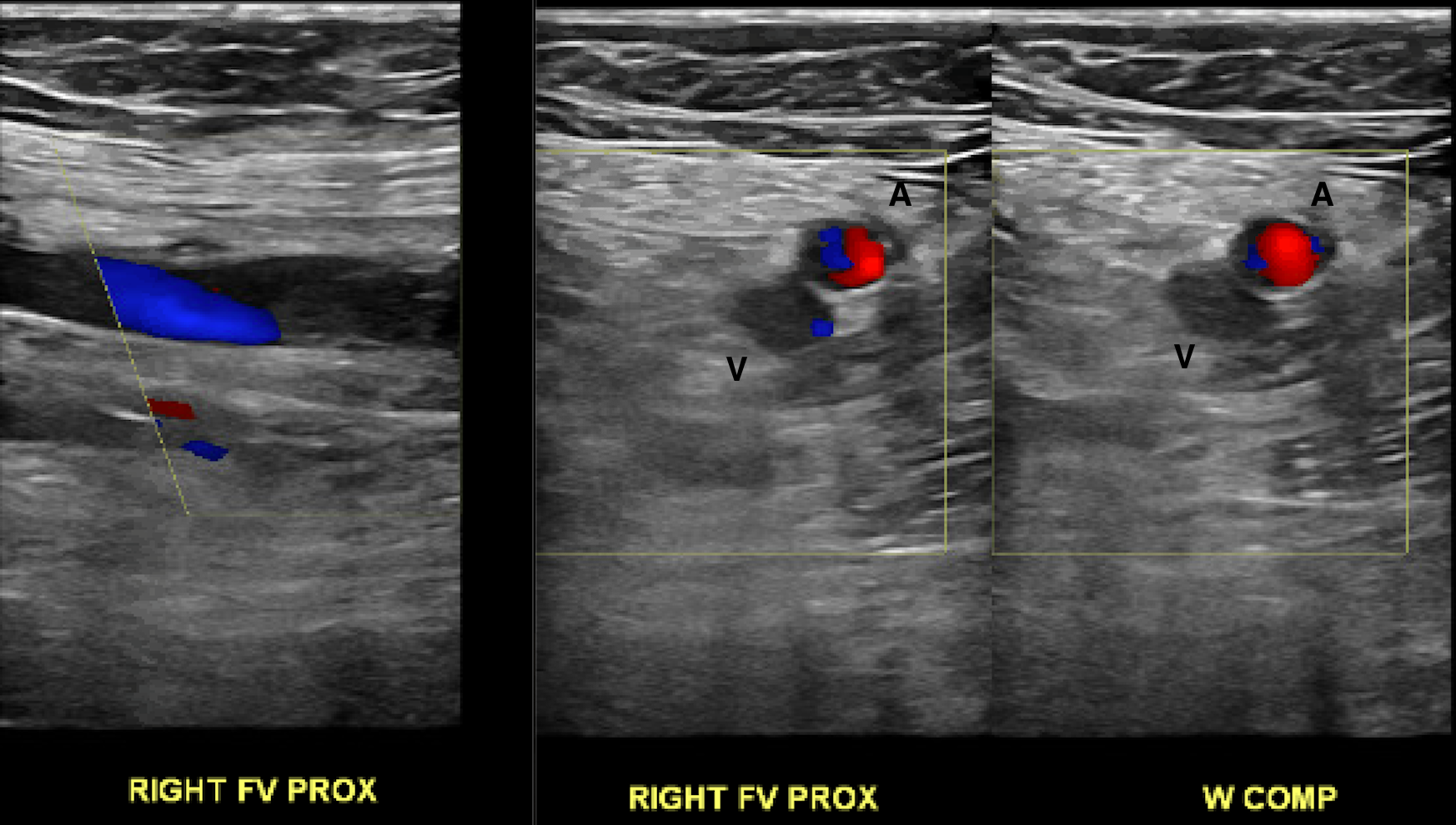 Acute, Occlusive Deep Venous Thrombosis
Hypoechoic thrombus distends the vein